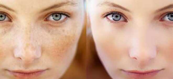 Как удалить веснушки с лица навсегда