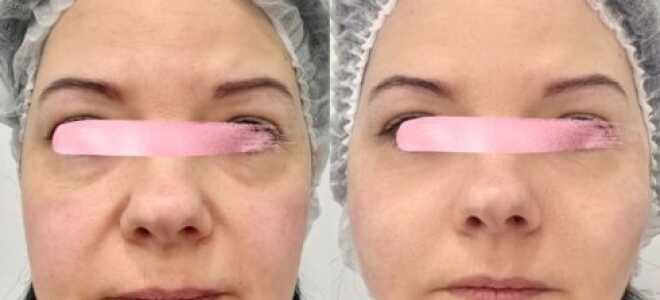 Лифтинг — Коги (нити с насечками)