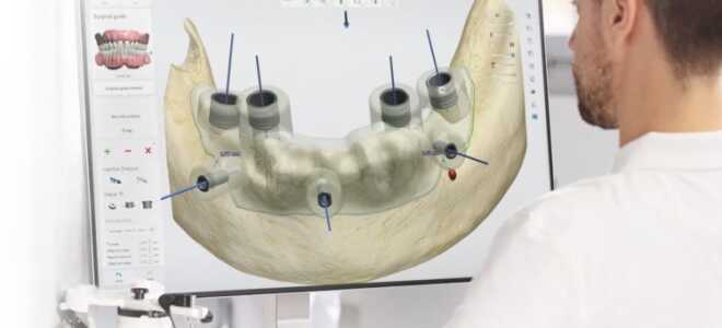 Методы имплантации зубов: современные способы восстановить зубы