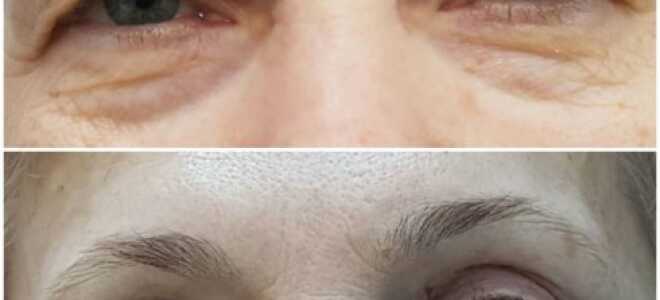 Блефароспазм у взрослых: причины, методы борьбы